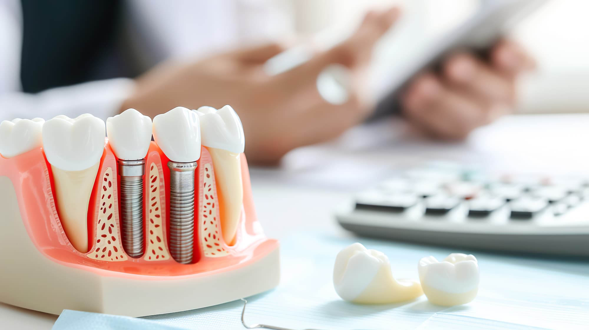 インプラント治療と費用のイメージ