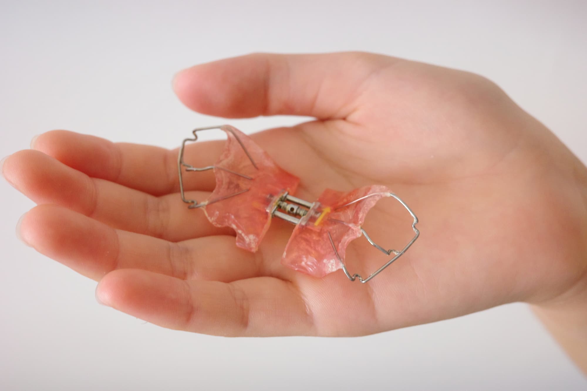 庄矯正の装置を乗せた子どもの手