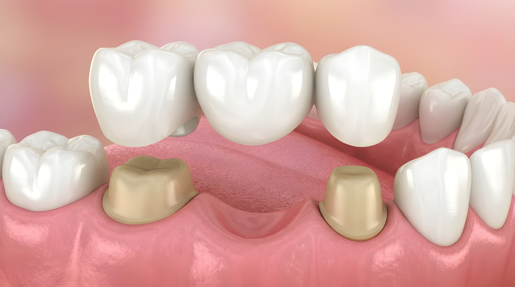 ブリッジ治療のイメージ